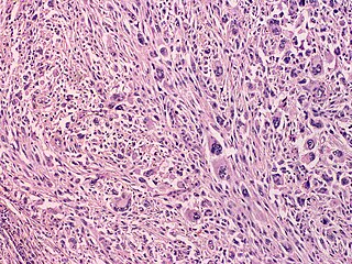 <span class="mw-page-title-main">Atypical fibroxanthoma</span> Medical condition