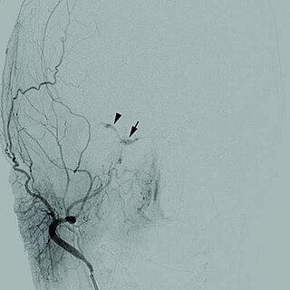 <span class="mw-page-title-main">Cerebrovascular disease</span> Condition that affects the arteries that supply the brain