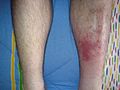 Cellulitis