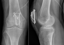 Tension band wiring: front and side view Zuggurtungs-Osteosynthese bei Patella-Querfraktur.png