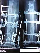 Two X-ray perspectives show the callus forming at the fracture site, three months post-fracture.