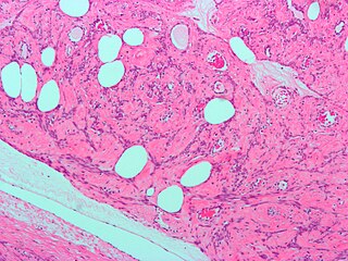 <span class="mw-page-title-main">Leiomyoma</span> Medical condition