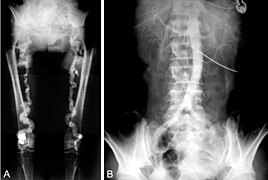 July 5: medical imaging showing Monckeberg's arteriosclerosis