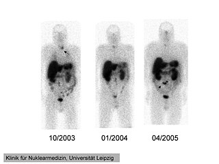 <span class="mw-page-title-main">Octreotide scan</span>