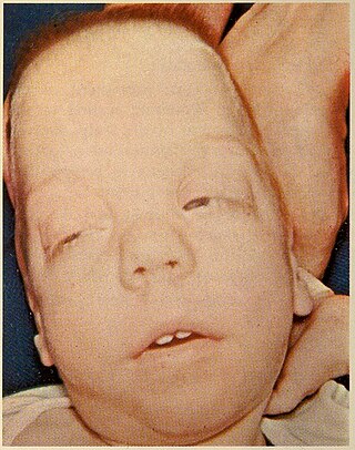 <span class="mw-page-title-main">Smith–Lemli–Opitz syndrome</span> Recessive genetic condition