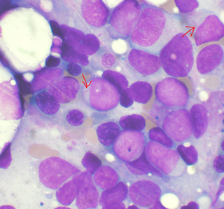 <span class="mw-page-title-main">Acute myeloid leukemia</span> Cancer of the myeloid line of blood cells