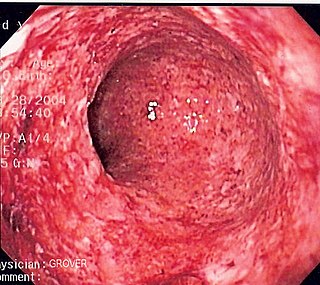 <span class="mw-page-title-main">Crohn's disease</span> Type of inflammatory bowel disease