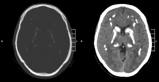 <span class="mw-page-title-main">Primary familial brain calcification</span> Indiana genetic disorder involving calcification of the basal ganglia