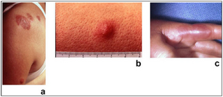 Febrile neutrophilic dermatosis Medical condition