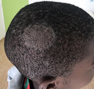 <span class="mw-page-title-main">Tinea capitis</span> Cutaneous fungal infection of the scalp