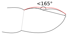 Clubbing of the fingernail: The red line shows the outline of a clubbed nail. Clubbing.svg