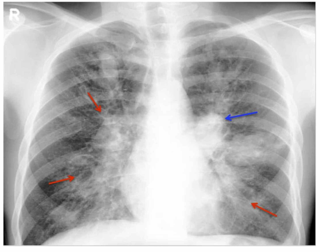 <span class="mw-page-title-main">Allergic bronchopulmonary aspergillosis</span> Medical condition