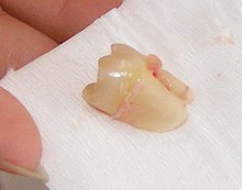 Extracted wisdom tooth that was horizontally impacted Extracted Wisdom Tooth.jpg