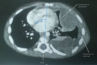 <span class="mw-page-title-main">Soft-tissue sarcoma</span> Malignant tumor that develops in soft tissue