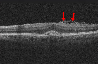 <span class="mw-page-title-main">Epiretinal membrane</span> Eye disease