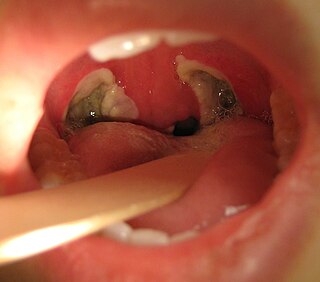 <span class="mw-page-title-main">Tonsillectomy</span> Surgical removal of the tonsils