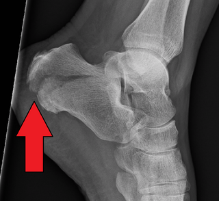 <span class="mw-page-title-main">Calcaneal fracture</span> Medical condition