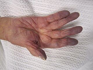 <span class="mw-page-title-main">Cyanosis</span> Decreased oxygen in the blood