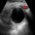 Mild gallbladder wall thickening of 3.5 mm in a person with acute cholecystitis as seen on ultrasound