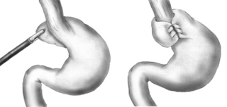 <span class="mw-page-title-main">Nissen fundoplication</span> Surgical procedure to treat gastric reflux and hiatal hernia