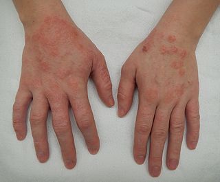 <span class="mw-page-title-main">Dermatitis</span> Inflammatory disease of the skin