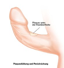 Dorsal deviation of the penis due to Peyronie's disease Dorsale Deviation.jpg