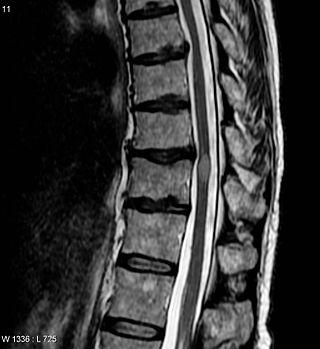 <span class="mw-page-title-main">Transverse myelitis</span> Medical condition of the spinal cord