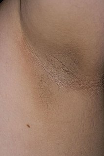 Acanthosis nigricans Human disease