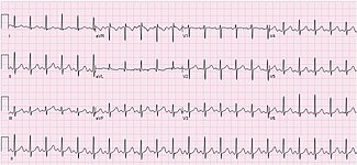 ECG of a 33-year-old female showing sinus tachycardia at 132 bpm