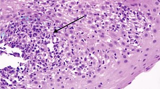 <span class="mw-page-title-main">Lymphocytic esophagitis</span> Medical condition