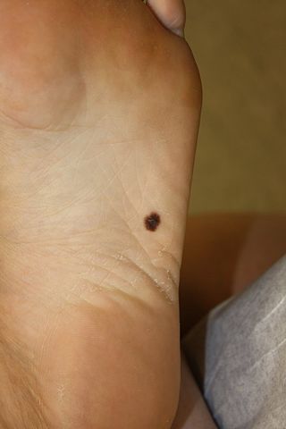 <span class="mw-page-title-main">Acral lentiginous melanoma</span> Type of skin cancer