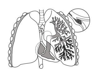 <span class="mw-page-title-main">Pulmonary embolism</span> Blockage of an artery in the lungs