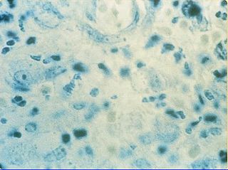 Granuloma inguinale bacterial disease caused by Klebsiella granulomatis (formerly known as Calymmatobacterium granulomatis) characterized by genital ulcers