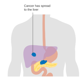 Estágio M1: Cancro pancreático metastatizado