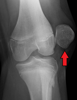 Patellar dislocation Medical condition