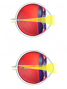 Astigmatism.jpg