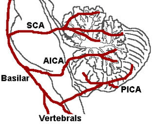 <span class="mw-page-title-main">Posterior inferior cerebellar artery</span>