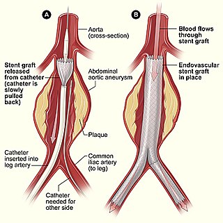 <span class="mw-page-title-main">Endovascular aneurysm repair</span> Surgery used to treat abdominal aortic aneurysm