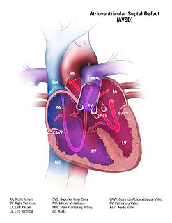 Atrioventricular septal defect Medical condition