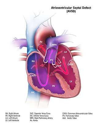 <span class="mw-page-title-main">Atrioventricular septal defect</span> Medical condition