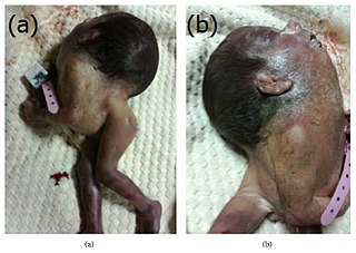 <span class="mw-page-title-main">Iniencephaly</span> Rare neural tube defect characterised by fusion of the occiput with the spine