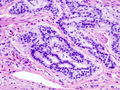 Cancer – Histopathologic image of colonic carcinoid