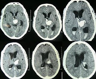 <span class="mw-page-title-main">Intraventricular hemorrhage</span> Medical condition