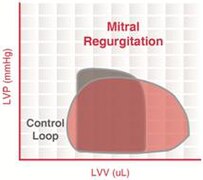 Mitral regurgitation.jpg