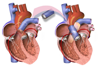 <span class="mw-page-title-main">Ross procedure</span> Type of cardiac surgical operation