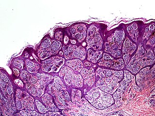 <span class="mw-page-title-main">Nevoid melanoma</span> Type of skin cancer