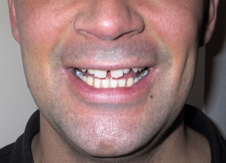 <span class="mw-page-title-main">Diastema</span> Gap between two teeth