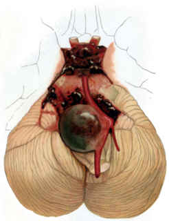 Intracranial aneurysm Cerebrovascular disorder