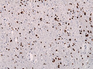 <span class="mw-page-title-main">Multiple system atrophy</span> Neurodegenerative disorder