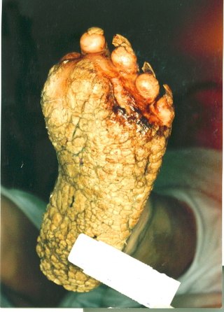 <span class="mw-page-title-main">Palmoplantar keratoderma</span> Medical condition